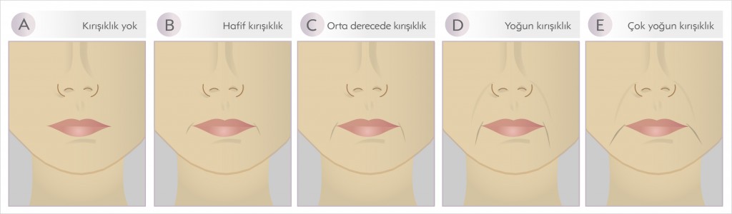 dudak köşelerindeki oluklar