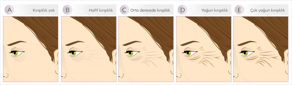 göz çevresi kırışıklıkları